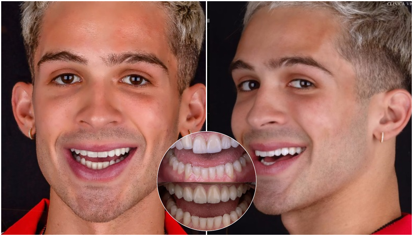 João Guilherme escurece lentes de contato para ter dentes mais naturais: veja antes e depois