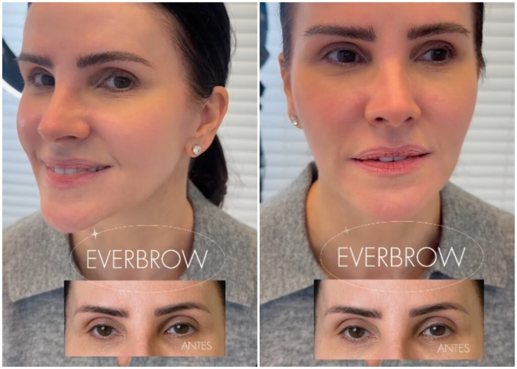 transplante de sobrancelha antes e depois