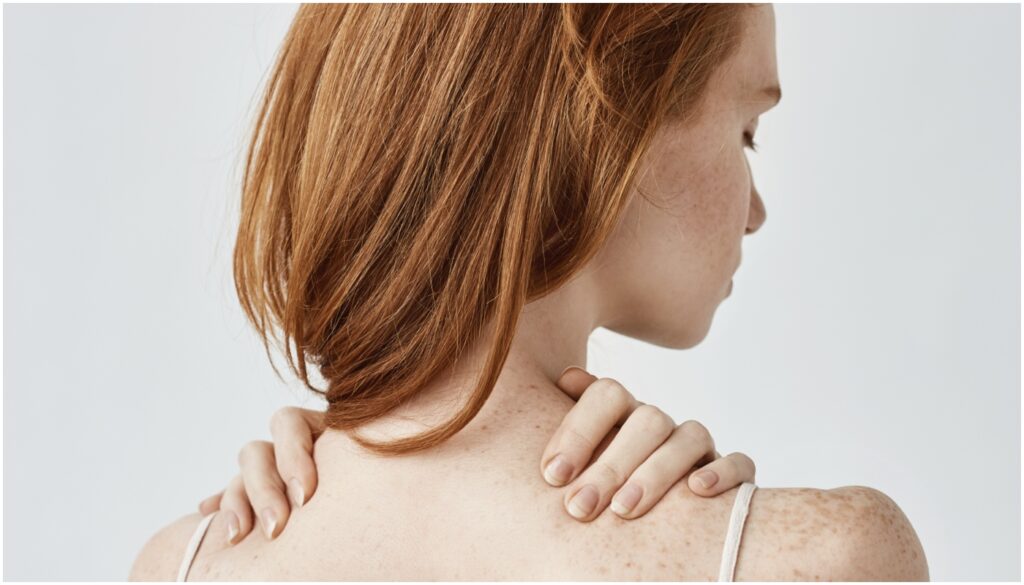 acne costas