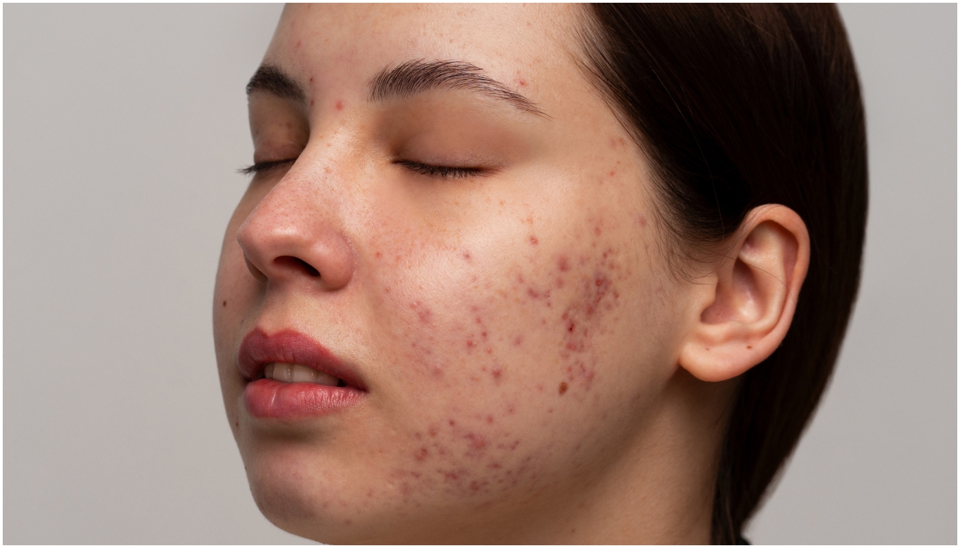 acne mulher adulta