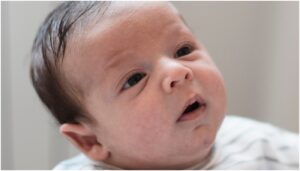 acne neonatal