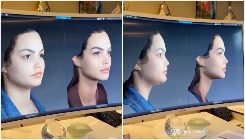 Suzanna Freitas, rosto derretido