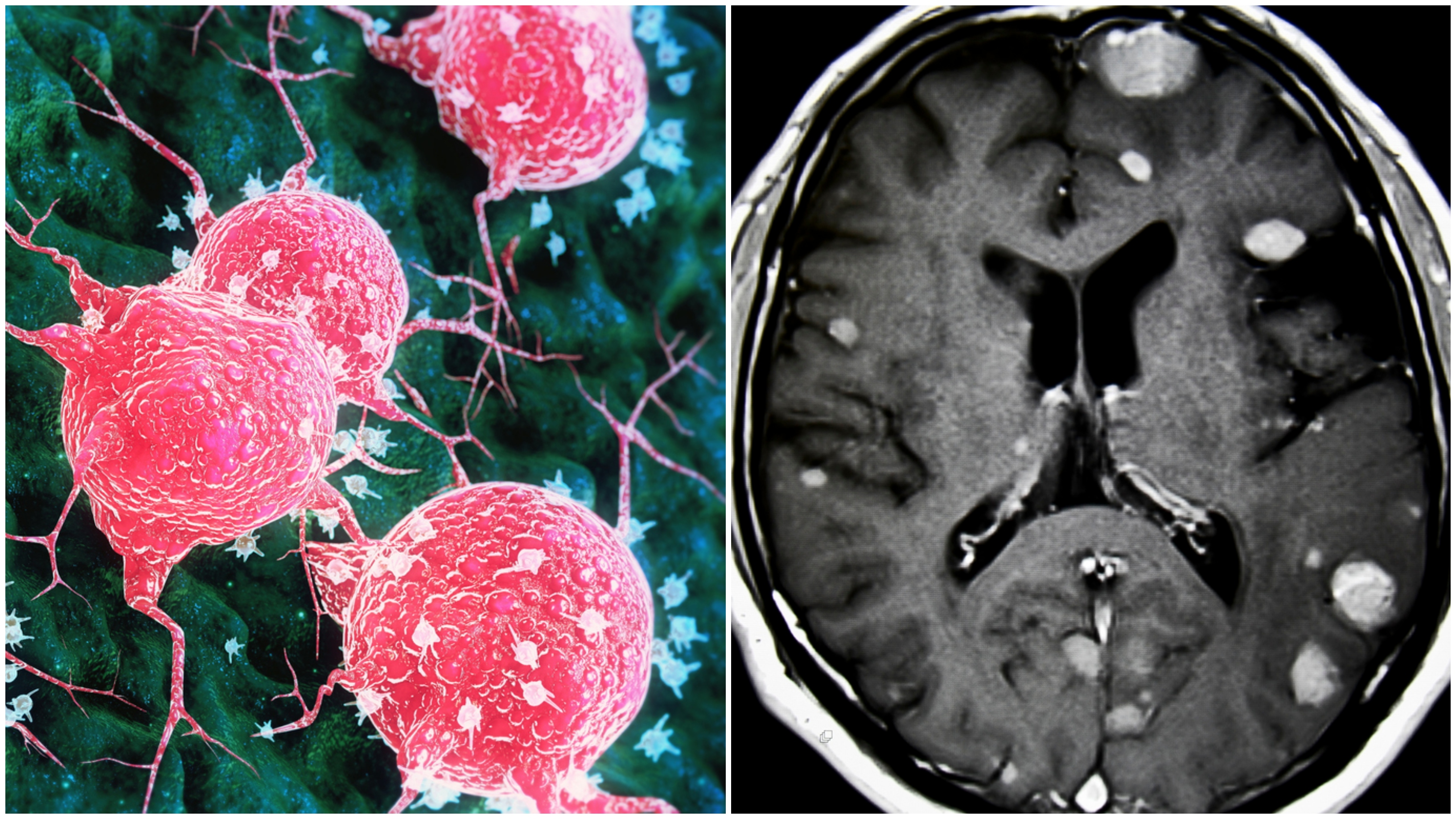 Câncer de pulmão tem tendência alta de apresentar metástase cerebral em sua evolução