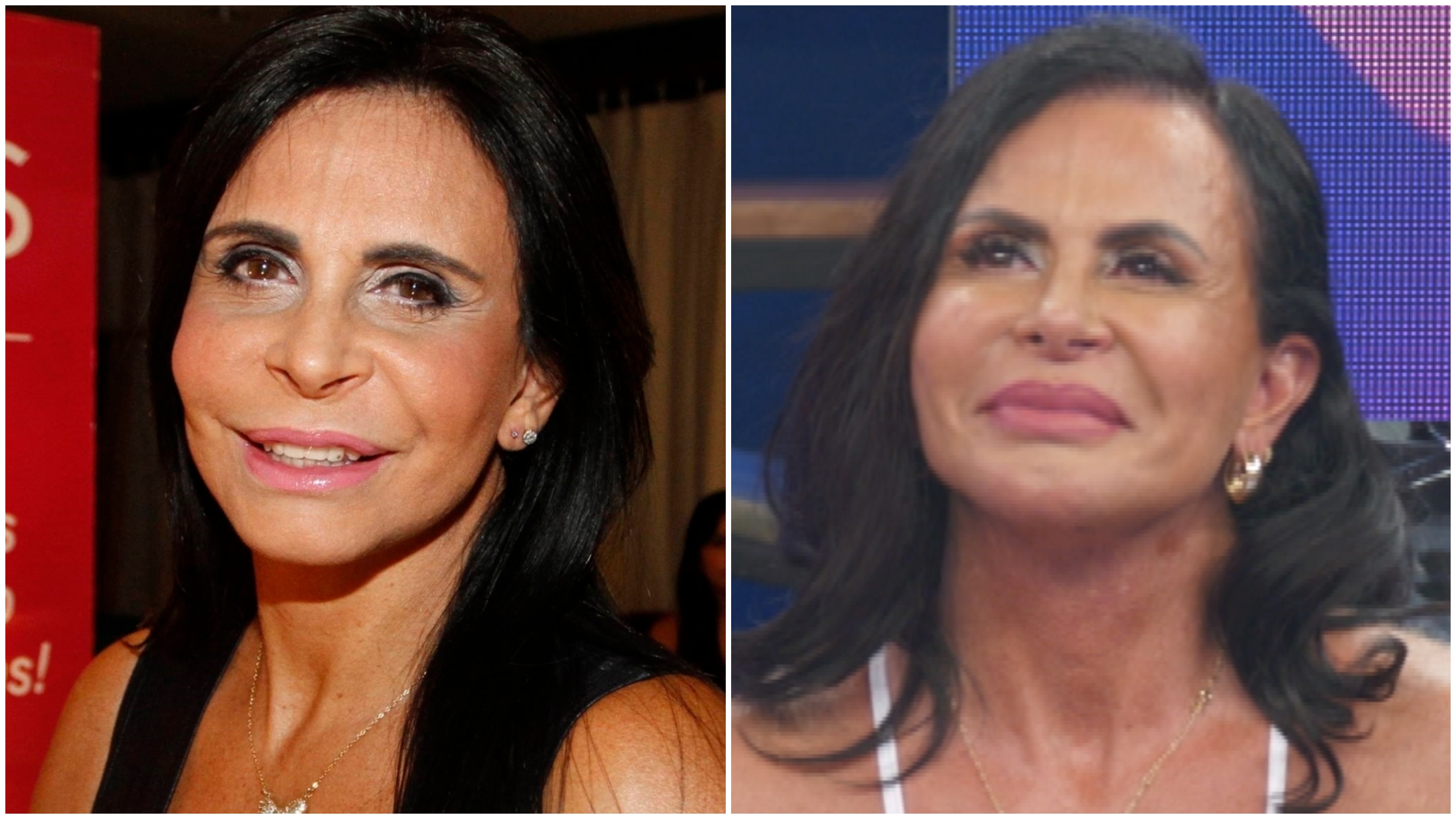 Gretchen antes e depois do preenchimento labial