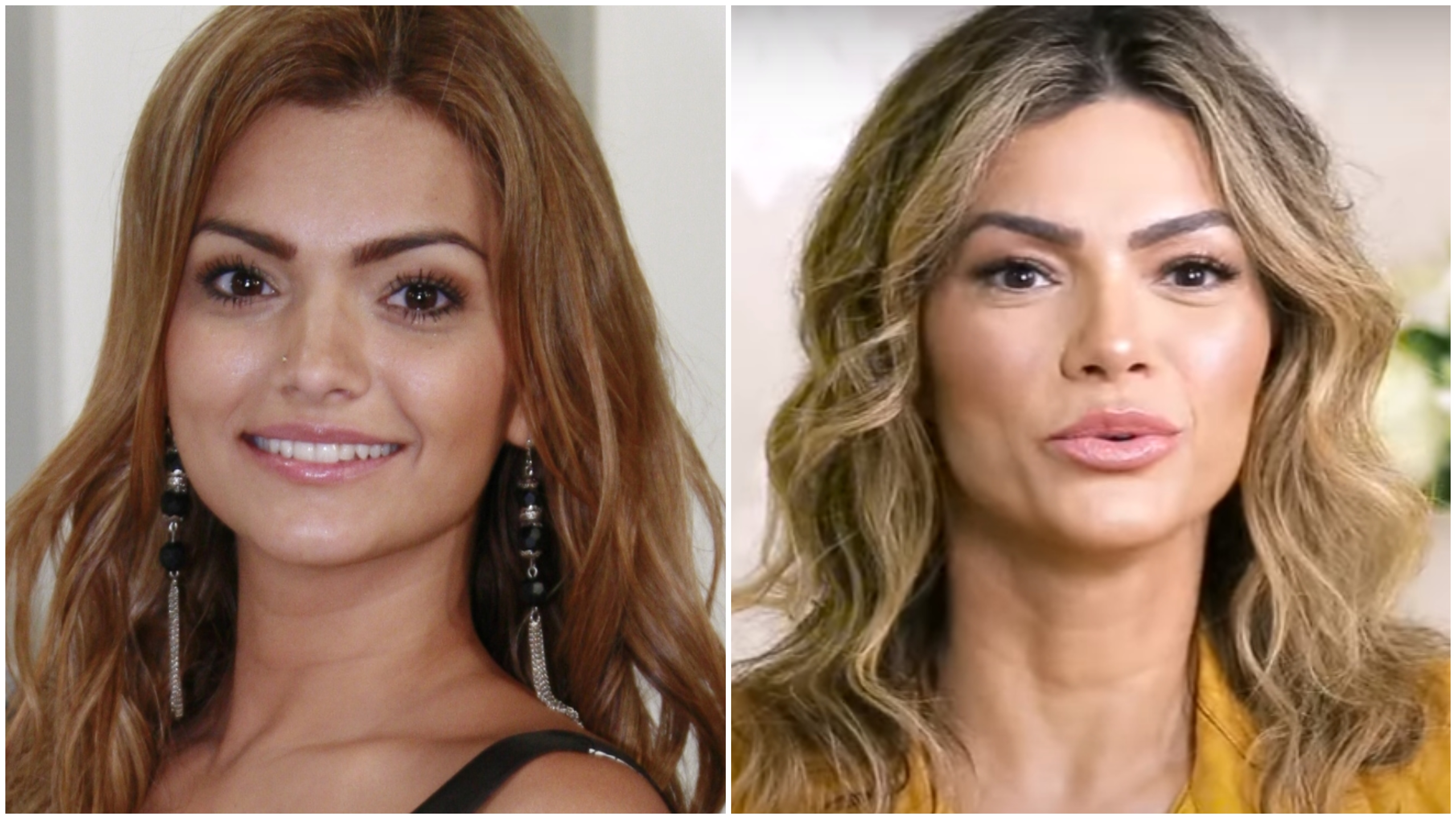 Kelly Key antes e depois do preenchimento labial