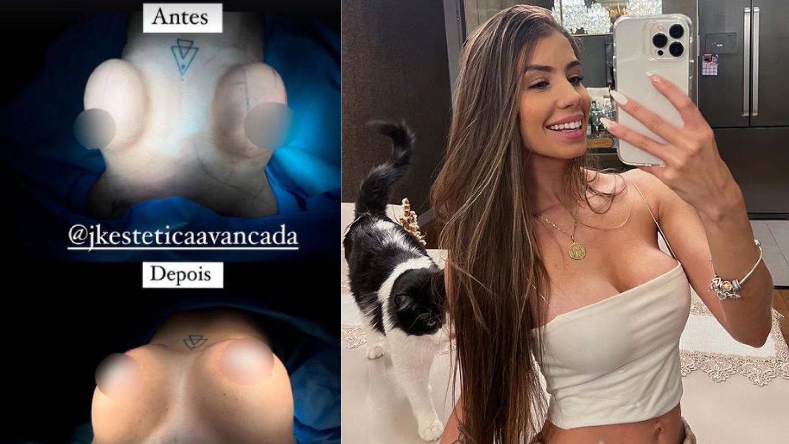 À esquerda, o antes e depois da mastopexia. Do outro lado, a imagem de Maria anterior às mudanças