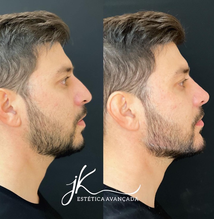Transformação de Caio por JK estética avançada.
