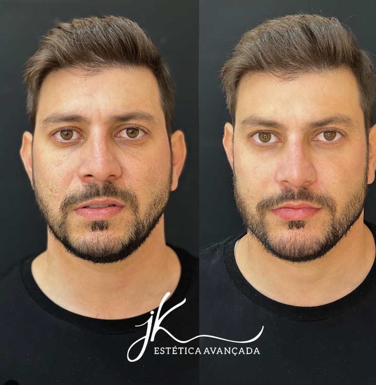 Transformação de Caio por JK estética avançada.