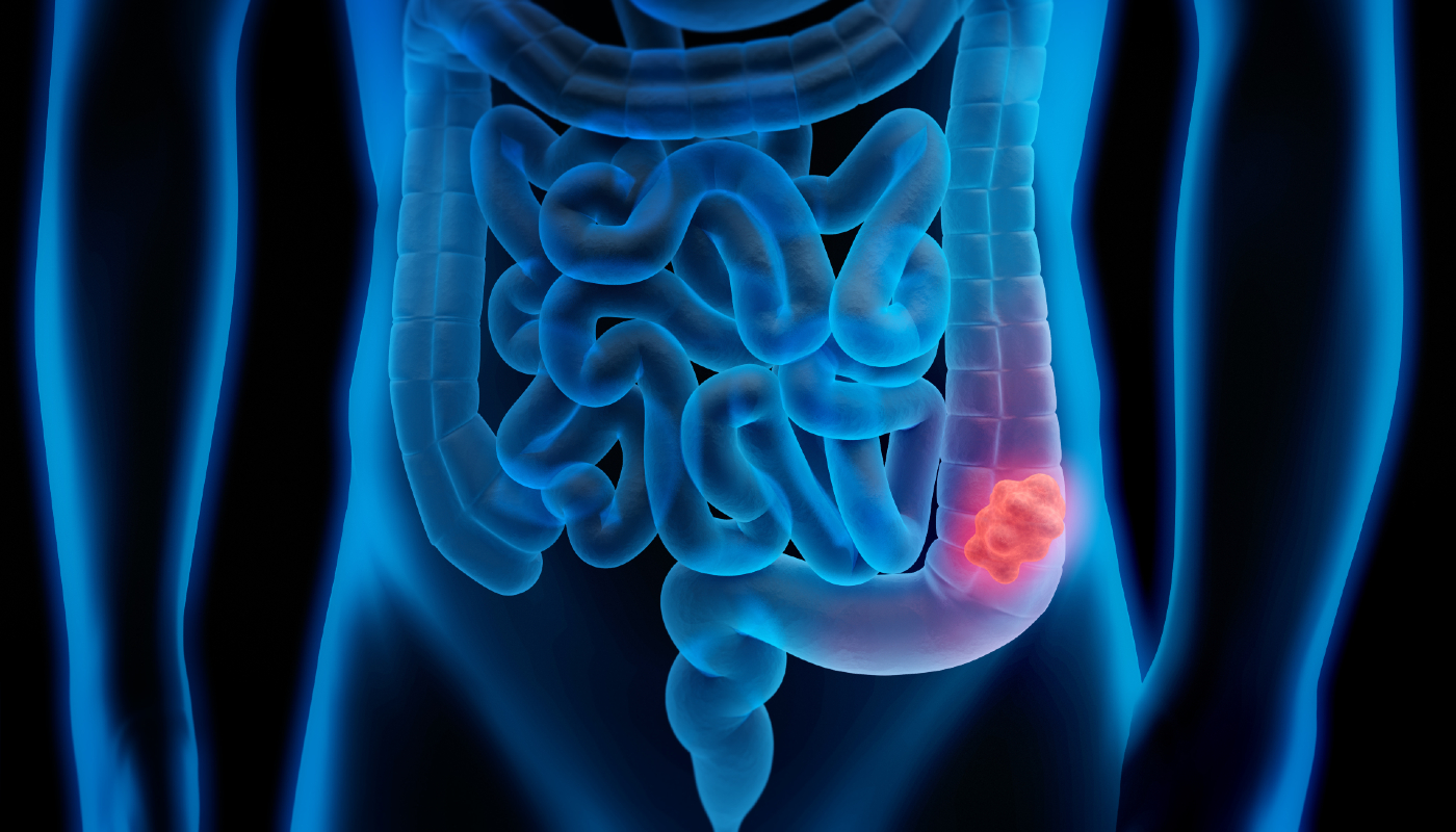 Câncer no intestino se inicia com o surgimento de um pólipo