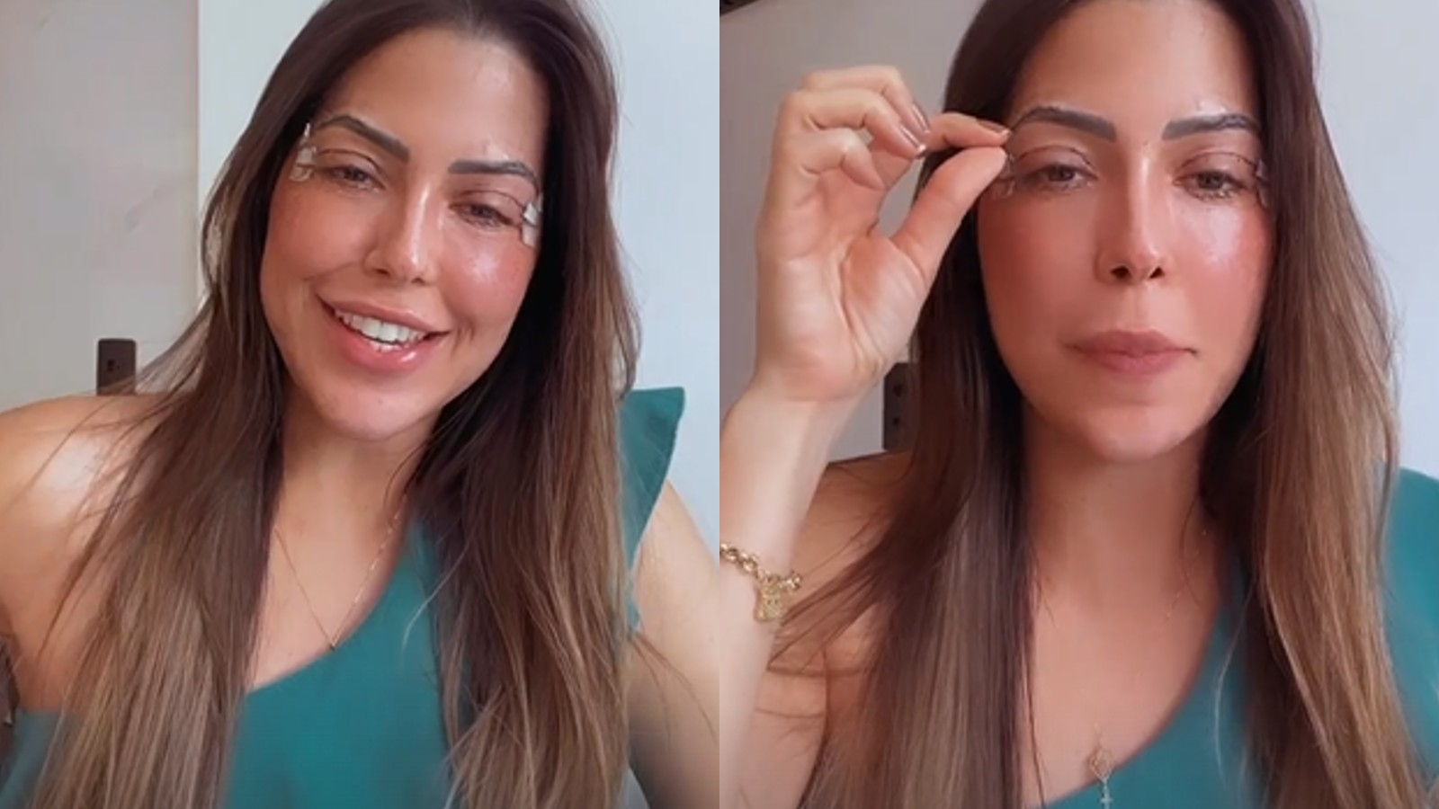 Laís Caldas faz cirurgia corretiva de ptose e diz que sofreu bullying por isso no “BBB”