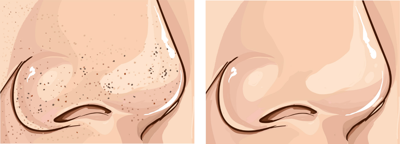 Como tirar cravos em casa sem deixar rosto marcado: passo a passo com receitas simples