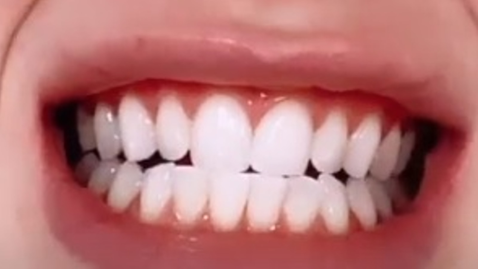 Clareamento dental de Luisa Sonza.