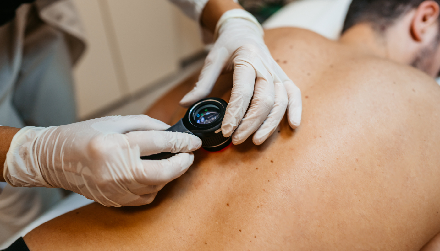 Entenda como funciona a vacina contra o melanoma