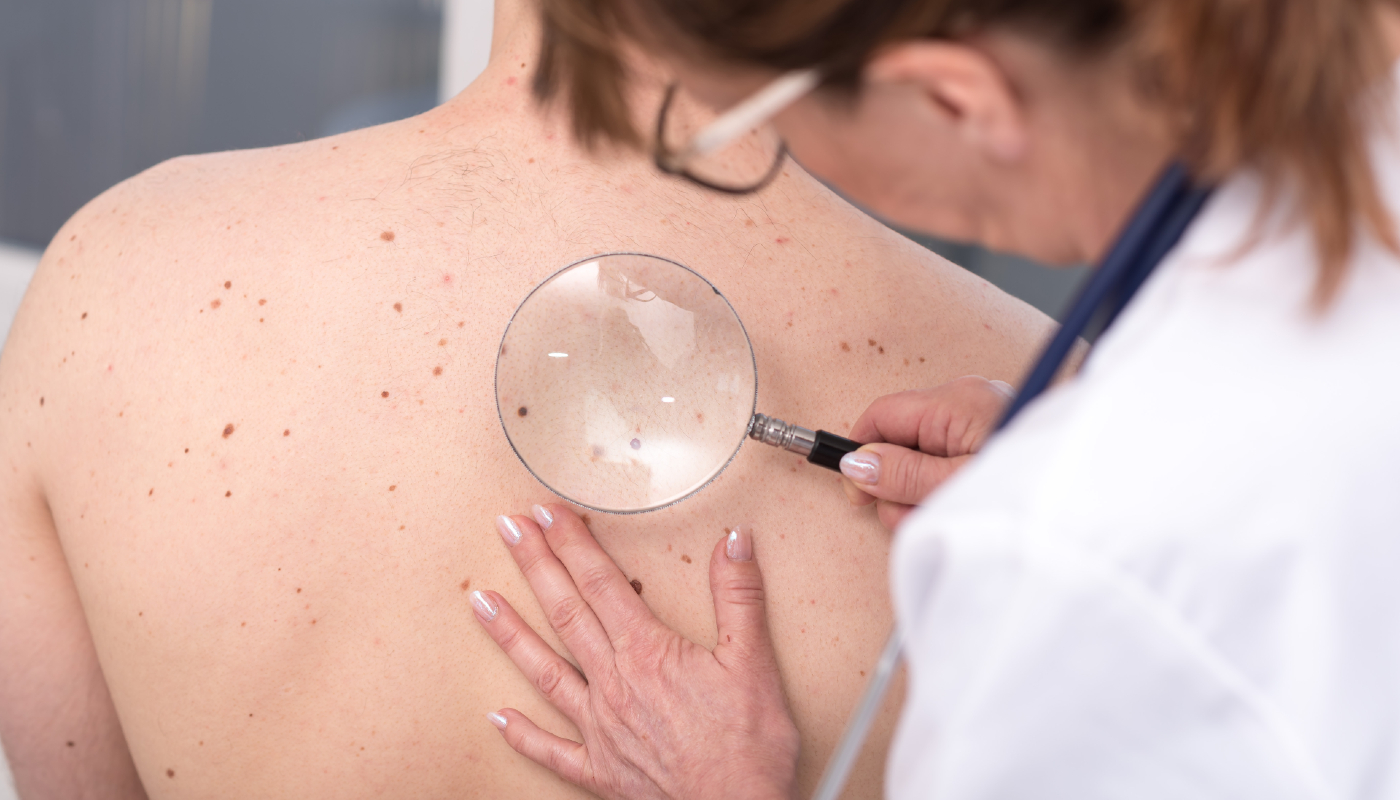 Melanoma é o câncer de pele que mais mata