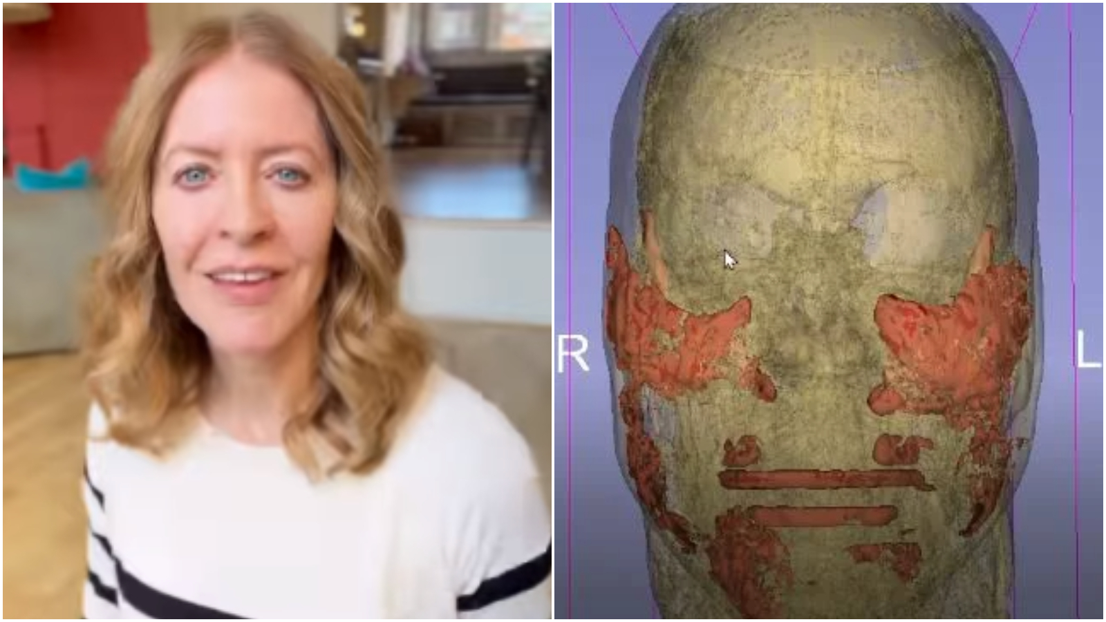 É perigoso ainda ter ácido hialurônico no rosto anos após aplicação, como ocorreu com jornalista?