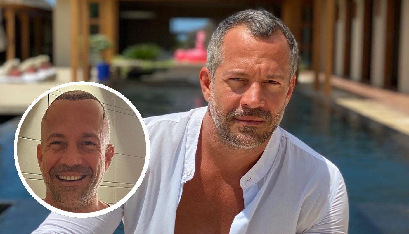 Famosos que fizeram transplante capilar e falaram abertamente sobre