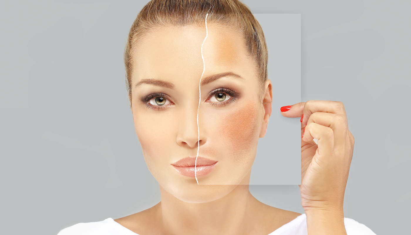 Qual é o melhor ácido para melasma?