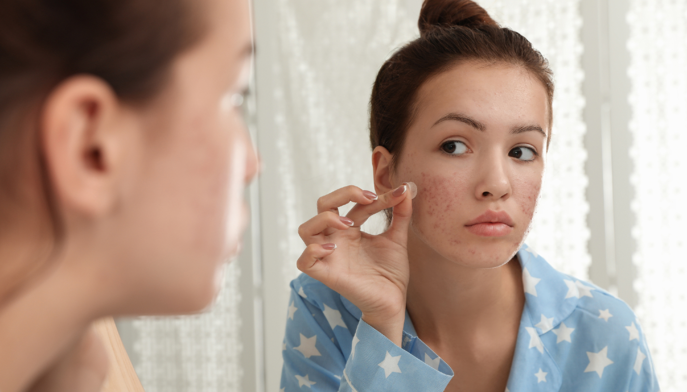 Acne: veja as 5 principais causas de acordo com o local do rosto
