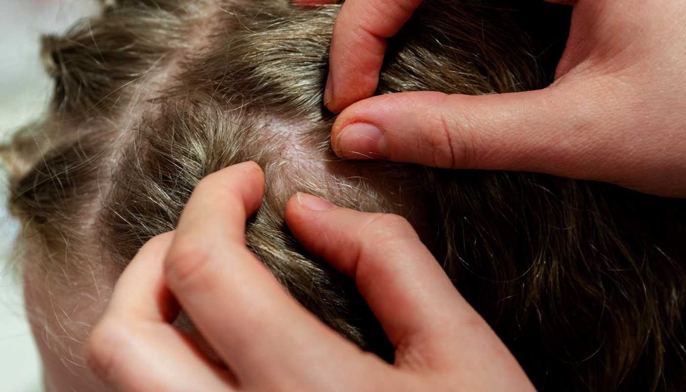 Filho de Luana Piovani e Pedro Scooby pega piolho pela 6ª vez: como evitar?